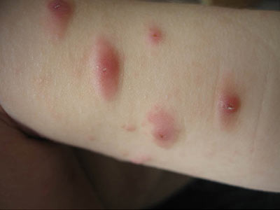 如何治疗过敏性荨麻疹